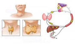 甲状腺囊肿发病的主要原因有哪些?