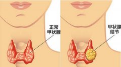 得了甲状腺结节能怀孕吗?