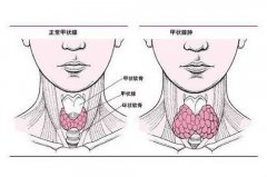 患上甲状腺肿大要注意哪些?