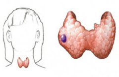 怎样确诊甲状腺结节呢？